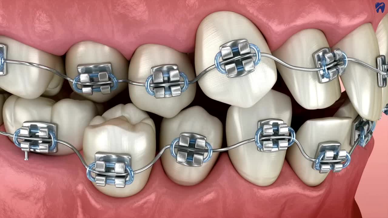 Brooklyn Clear Aligner Therapy | NY Dental Boutique